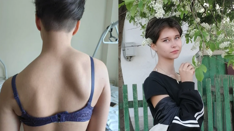 Новосибирские врачи выпрямили спину 15-летней девочки титаном