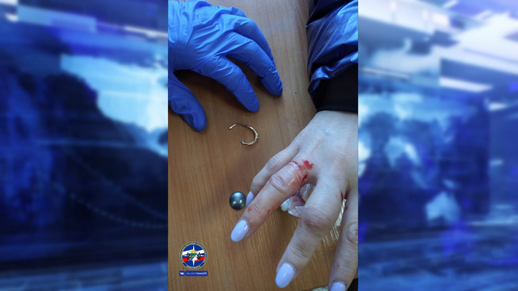 Спасатели помогли сибирячке снять кольцо с пальца, который прокусила собака