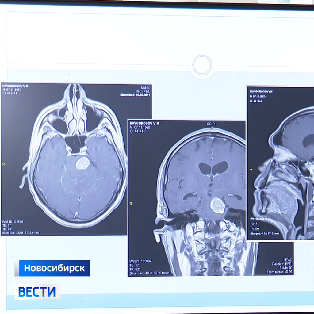 Операционная ─ родной дом: новосибирские нейрохирурги спасают жизни - Вести