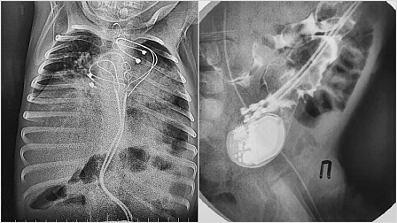 Новосибирские хирурги спасли малыша с проникшим в кишечник кардиостимулятором