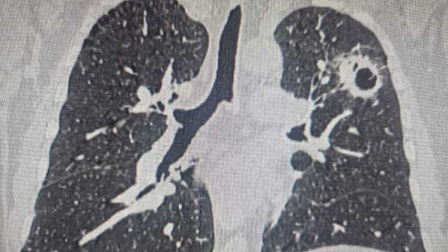 Новосибирские врачи спасли пациента с тремя раковыми опухолями